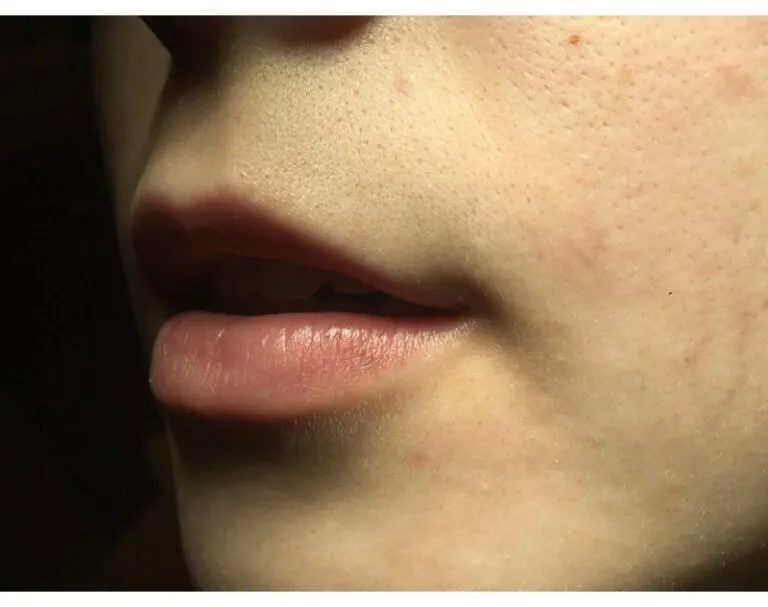 After_-Laser-Red-Venous-Lake-768×607