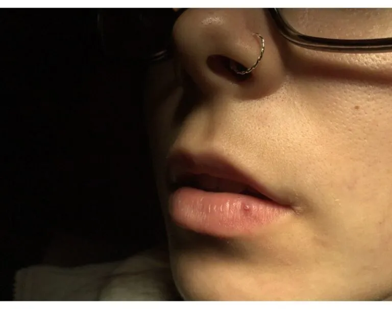 Before_-Laser-Red-Venous-Lake-768×607