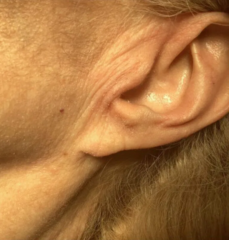 after_ear_lobe_repair-768×805