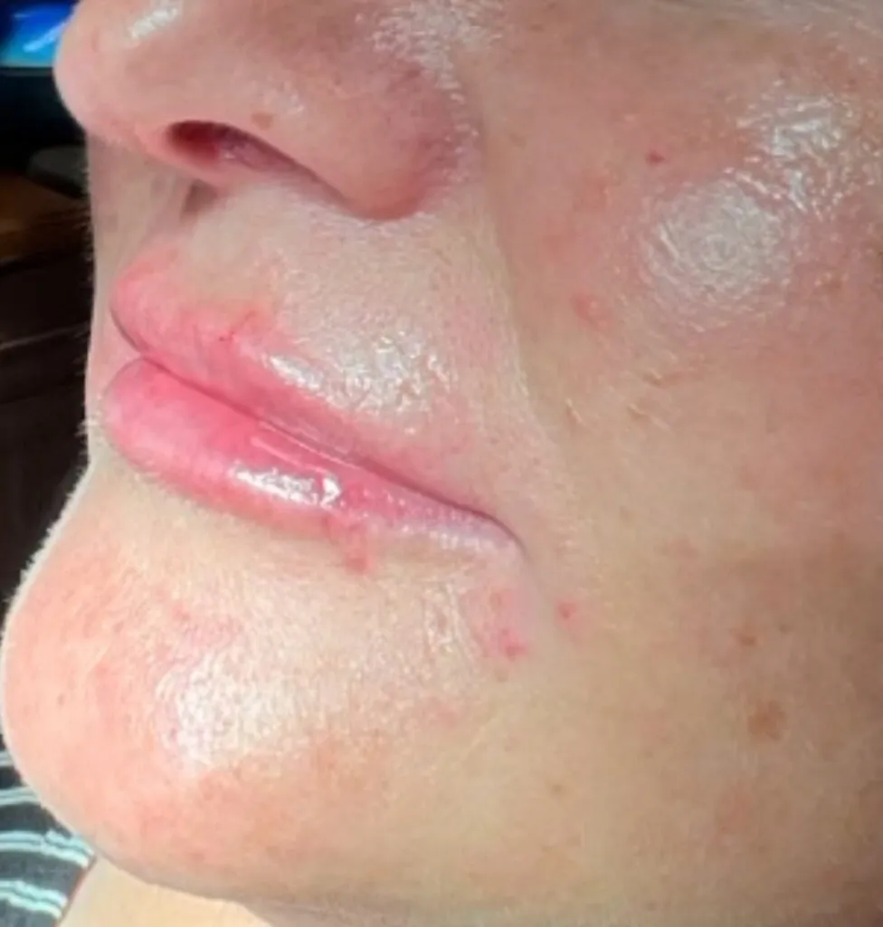 after_lip_filler1-976×1024