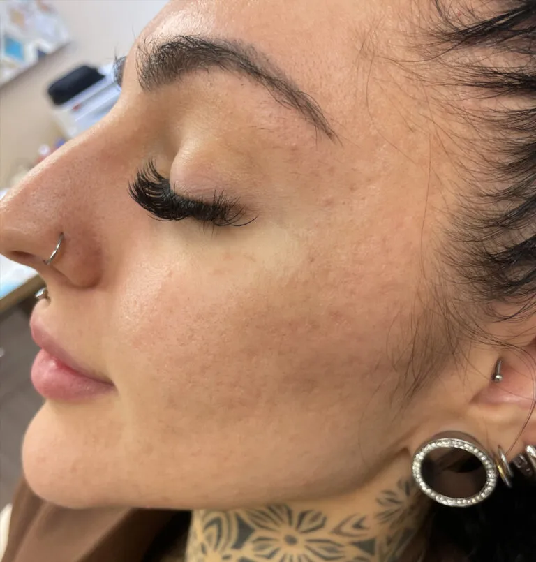 after_microneedling-768×805