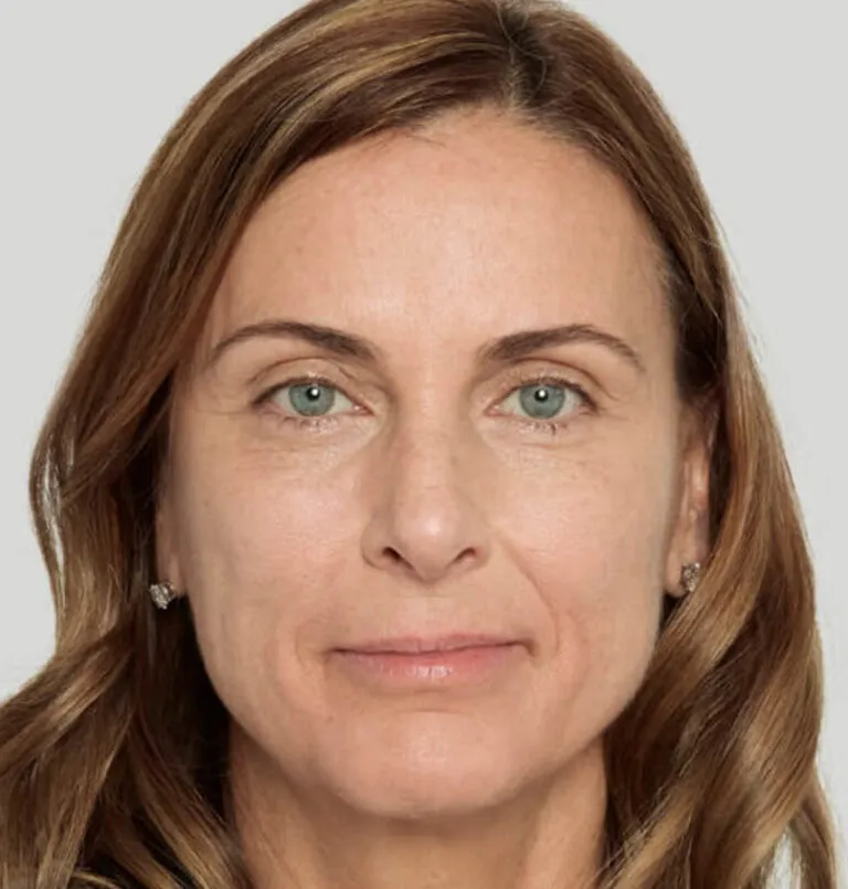 after_sculptra-768×805