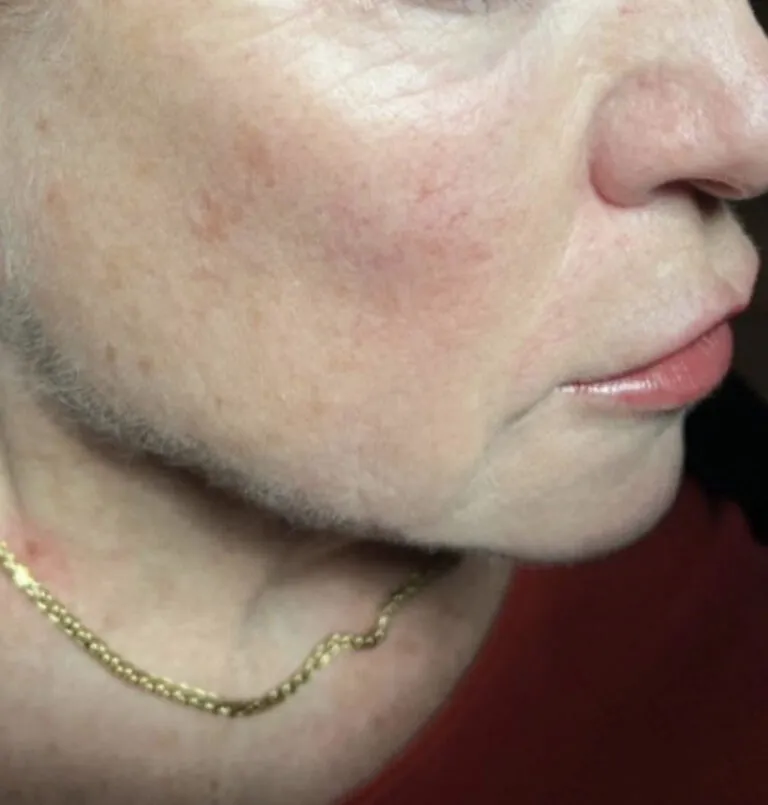after_ultherapy1-768×805