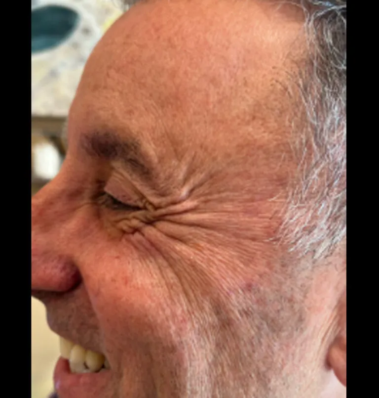 before_botox_crows_feet-768×805