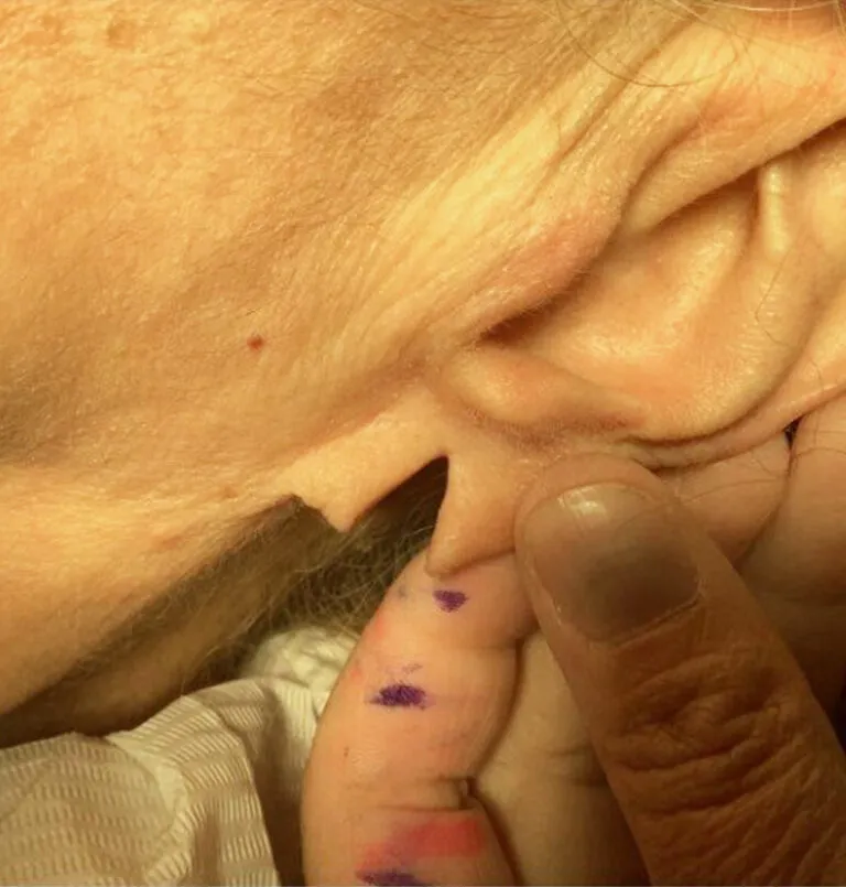 before_ear_lobe_repair-768×805