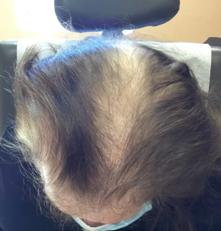 before_hairloss-768×805
