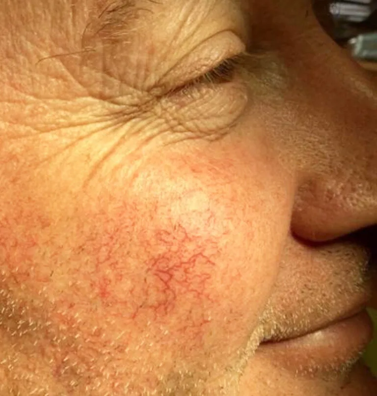 before_red_laser1-768×805