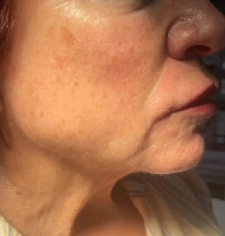 before_ultherapy1-768×805