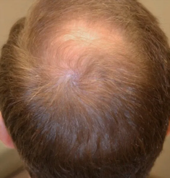 hairloss_before1