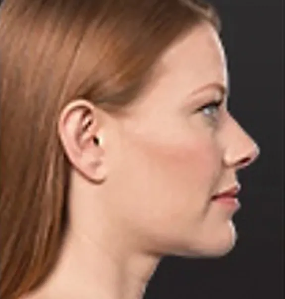 kybella_after1