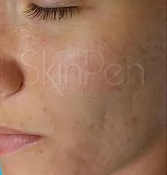 microneedling_after1