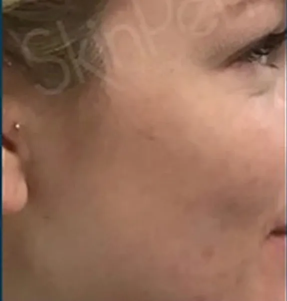 microneedling_after2