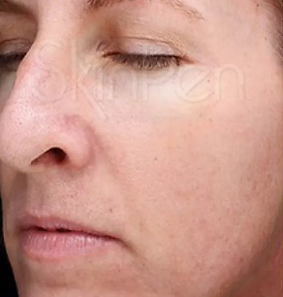 microneedling_after4