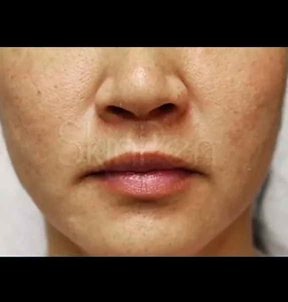 microneedling_after5