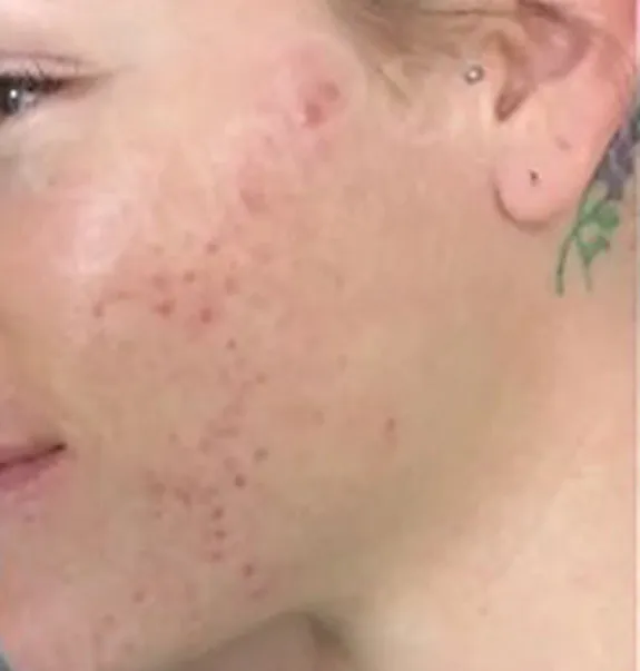 microneedling_before3