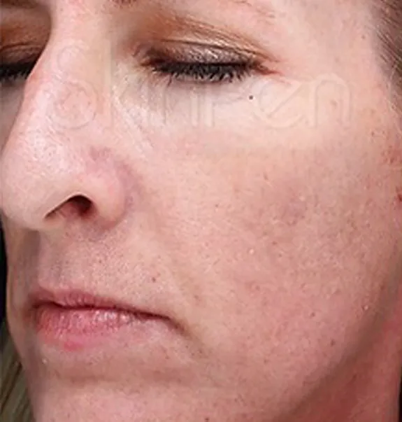 microneedling_before4