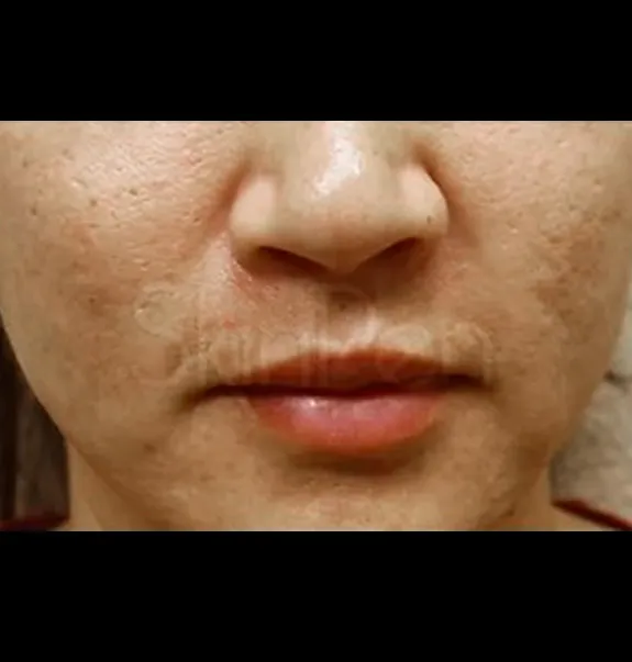 microneedling_before5