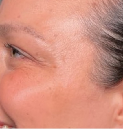 forehead botox before and after photos