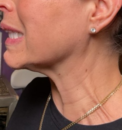 neck botox before and after photos