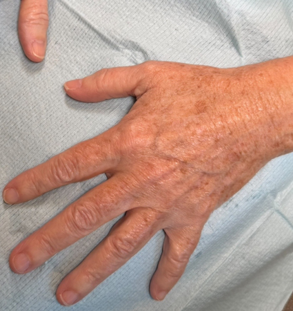 BBL hands before and after photos