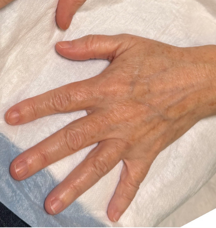 BBL hands before and after photos