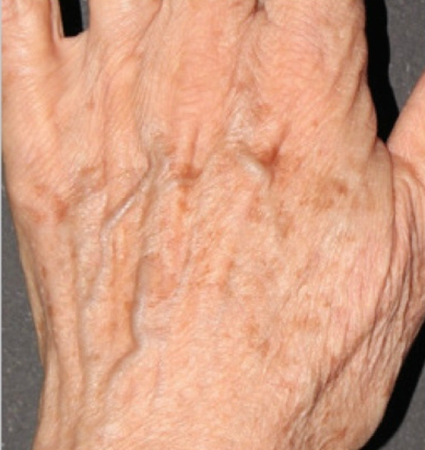 BBL hands before and after photos