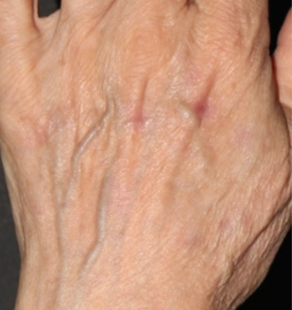 BBL hands before and after photos