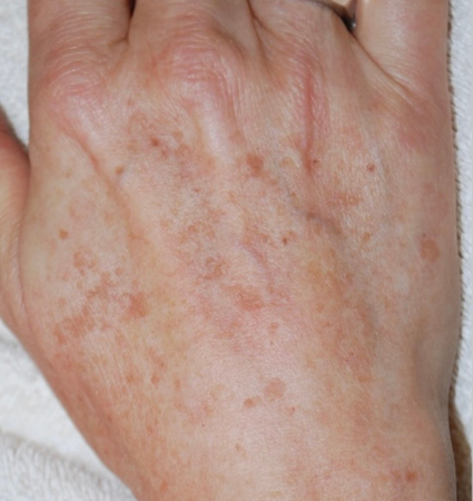 BBL hands before and after photos