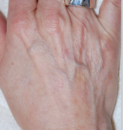 BBL hands before and after photos