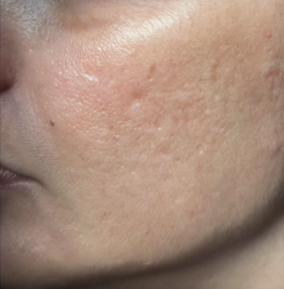 Chita left side acne scars-after