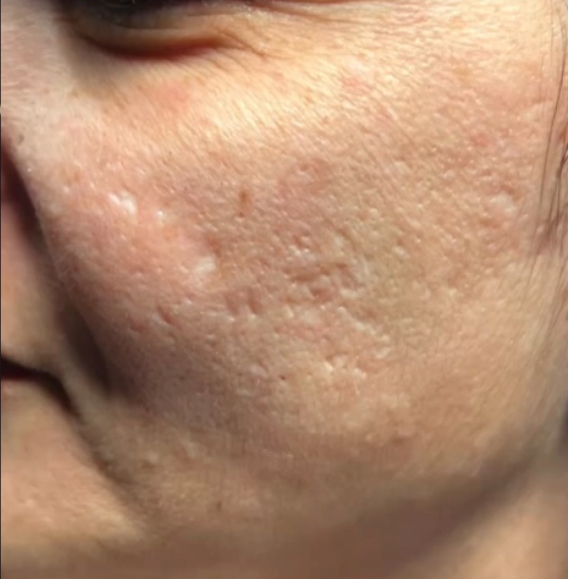 Chita left side acne scars-before