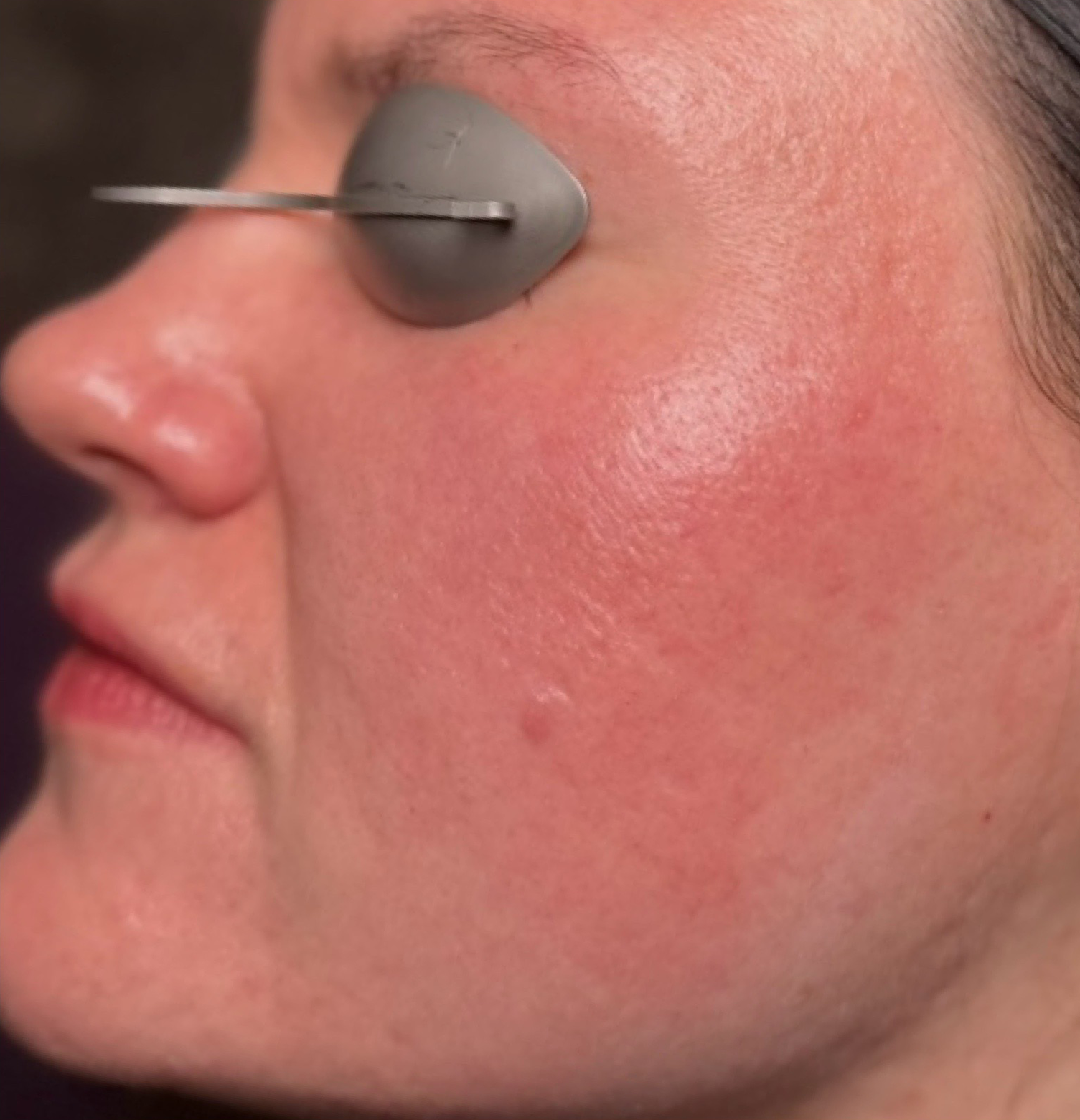 Comparison left AV-after