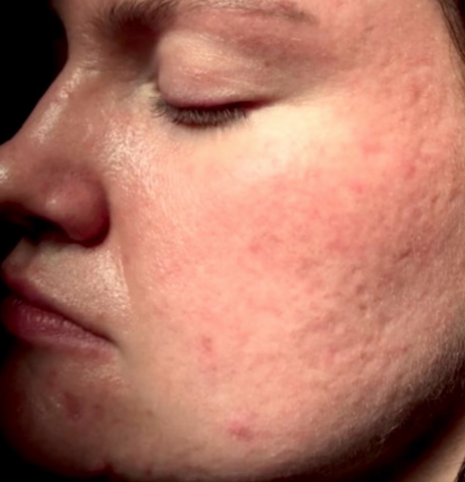 Comparison left AV-before