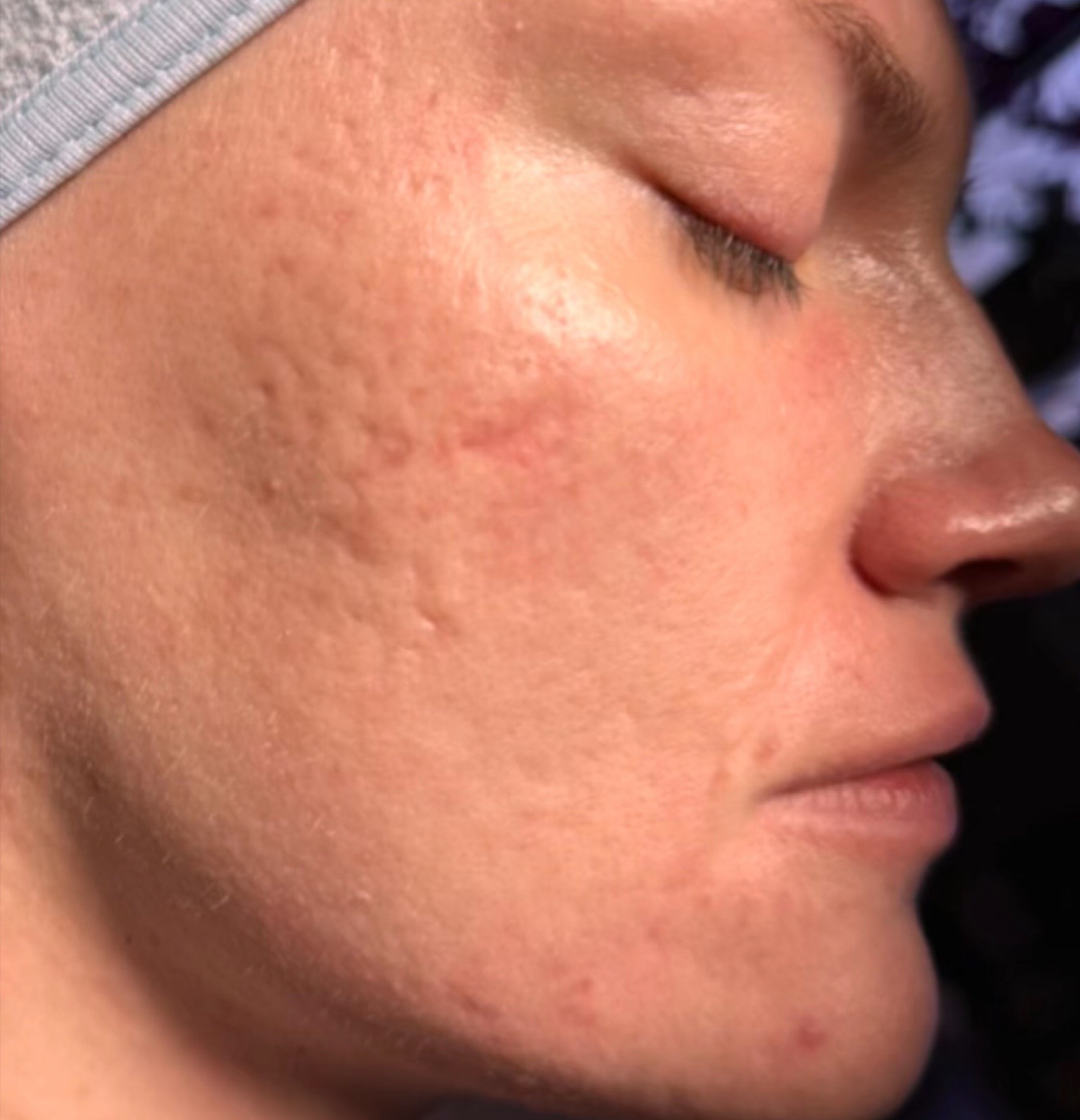 Comparison right AV-before