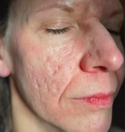 acne-scars-pt-A_01