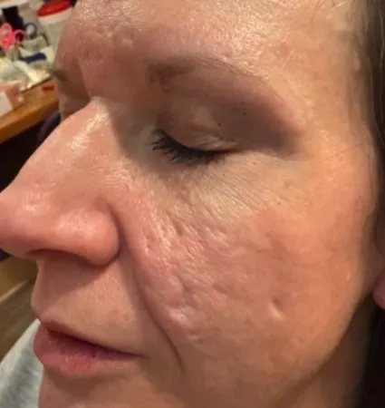 acne-scars-pt-A_03