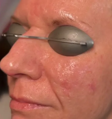 acne-scars-pt-A_04