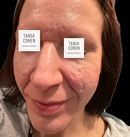 acne-scars-pt-A_05