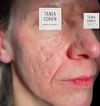 acne-scars-pt-A_07