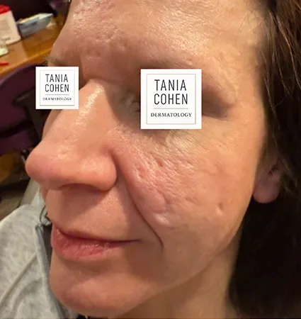 acne-scars-pt-A_09