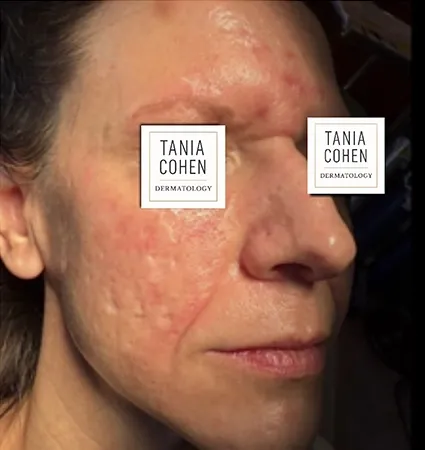 acne-scars-pt-A_11