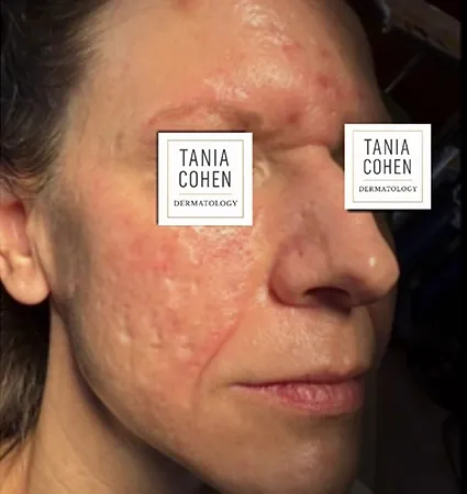 acne-scars-pt-A_13