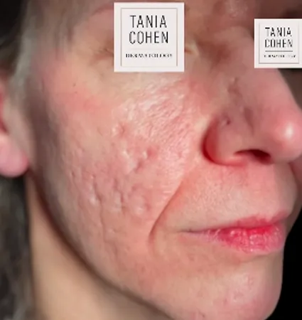 acne-scars-pt-A_15
