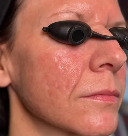 acne-scars-pt-A_16