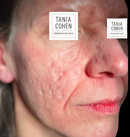acne-scars-pt-A_17