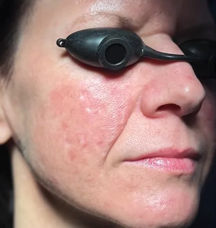 acne-scars-pt-A_18