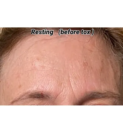 botox-pat-1-01