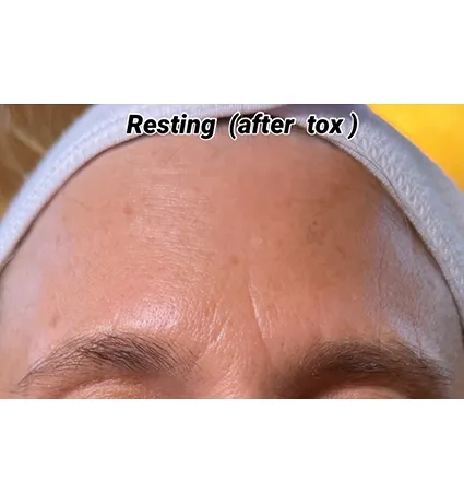 botox-pat-1-02