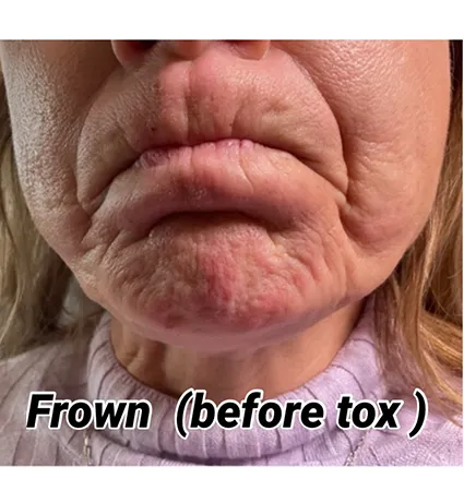 botox-pat-2-01