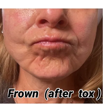 botox-pat-2-02